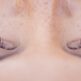 LaseMD Ultra : le traitement laser pour sublimer votre peau en douceur