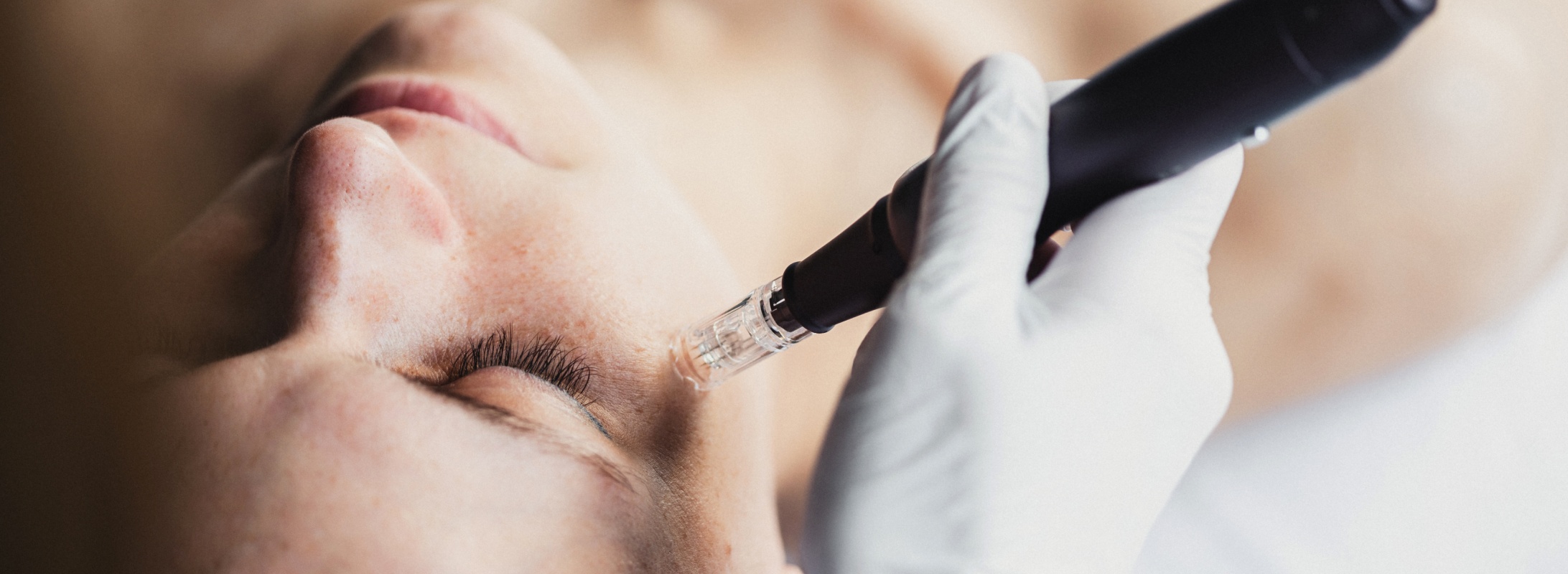 Microneedling