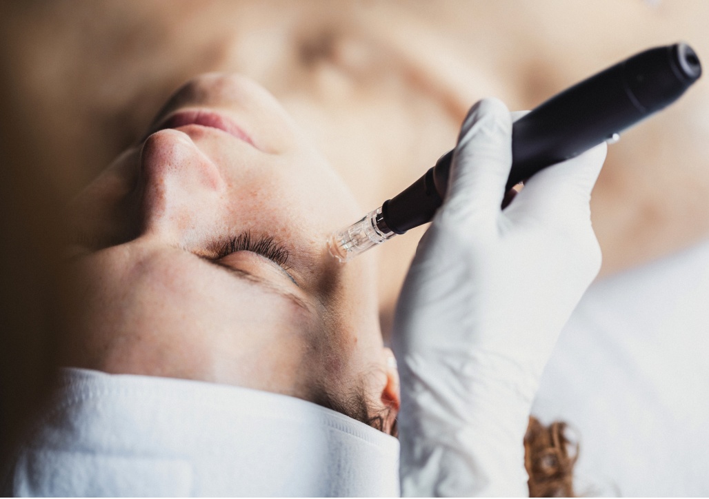 Microneedling