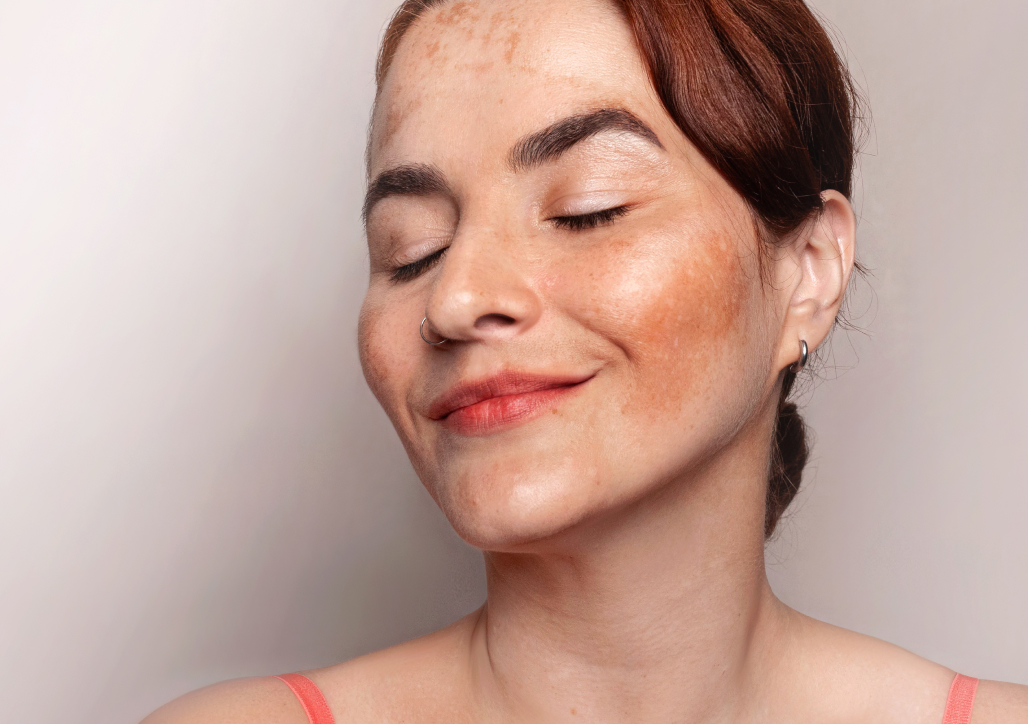 Combien séances laser pigmentaire nécessaires résultat optimal | Dr Nathaniel Khalifa | Montauban