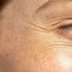 Botox pour les pattes d’oie : une solution efficace pour rajeunir le regard